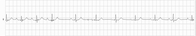 Wandering Atrial Pacemaker Rhythm Strip